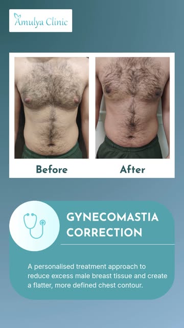 A more defined chest. A more confident you.

Gynecomastia can affect the appearance of the chest and