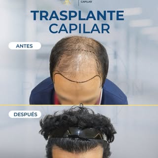 12 meses post trasplante capilar ✨

Este caso de éxito refleja cómo un trasplante capilar bien plani