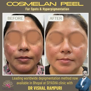 ✌🏻The world’s leading depigmentation treatment, Cosmelan Peel, is now available in Bhopal at SIYASH