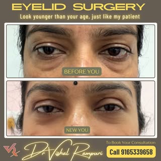 Incredible Transformation with Upper & Lower Eyelid Surgery!
Puffy, sagging eyelids can make you loo