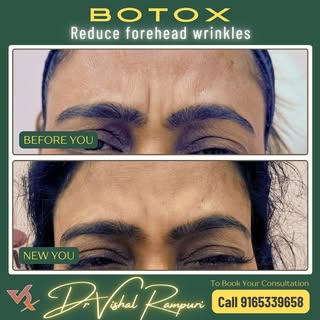 Fine lines on the forehead and around the eyes? Smoothed out beautifully with Botox! 💉
Swipe to see