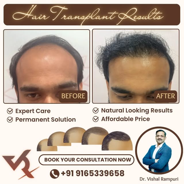 Witness a stunning hair transformation at Siyasha Clinic, Bhopal! Designed to restore confidence wit