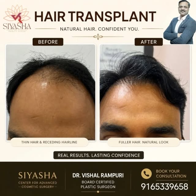 From a receding hairline to natural, fuller hair real transformations that speak for themselves! 

H