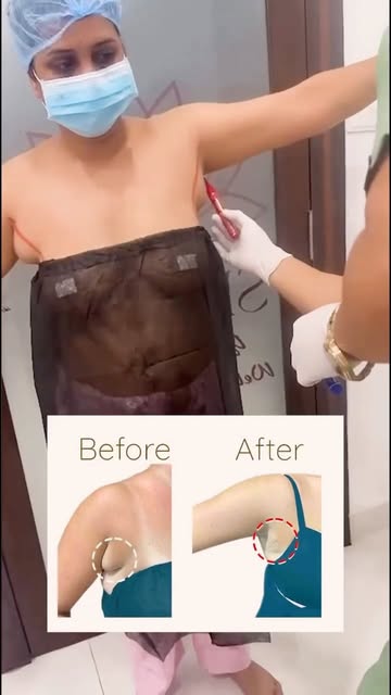 Accessory breast tissue in the underarm area is a condition where additional breast tissue develops 