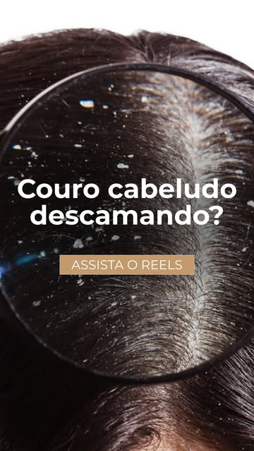Caspa, dermatite seborreica… Seu couro cabeludo está descamando? Então assista o vídeo!

@drasarahco