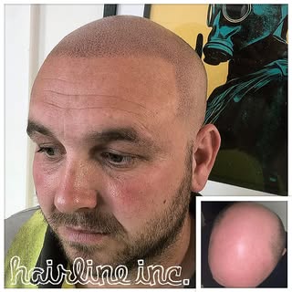 #scalpmicropigmentation #hairtattoo #spmu #pmu #hairtransplant