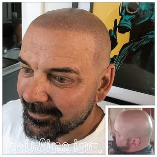 #scalpmicropigmentation #hairtattoo #spmu #pmu #hairtransplant