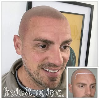 #scalpmicropigmentation #smp #spmu #pmu #hairtransplant