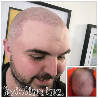 #scalpmicropigmentation #hairtattoo #spmu #pmu #hairtransplant