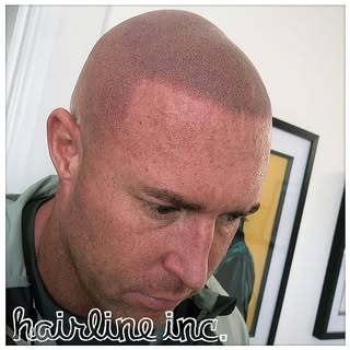 #scalpmicropigmentation #hairtattoo #spmu #pmu #hairtransplant