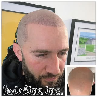 #scalpmicropigmentation #hairtattoo #spmu #pmu #hairtransplant