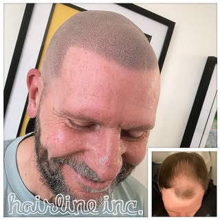 #scalpmicropigmentation #hairtattoo #spmu #pmu #hairtransplant