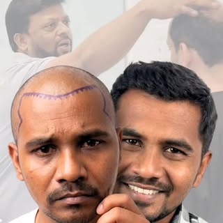 Hair Transplant Before & After Results | Natural Hairline & Dense Coverage
Performed by Dr. Sadiq Ma