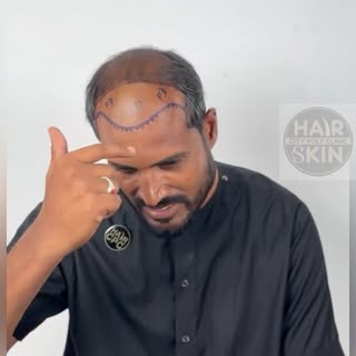 A happy patient is the biggest success for us. ✨

After getting his new hairline, our patient shared