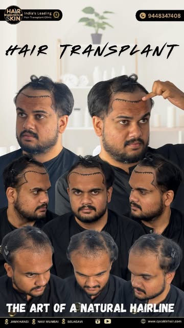 ✨ **FROM BEFORE HAIRLINE TO A NATURAL-LOOKING NEW HAIRLINE!** ✨

A well-designed hairline can make a