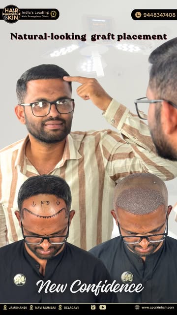 🔥 **FABULOUS HAIR TRANSPLANT RESULT!** 🔥

From hair loss concerns to a **more defined, natural-loo
