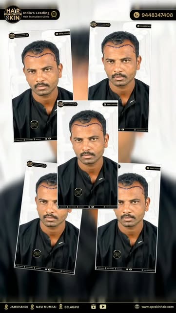 ✨ HAIR TRANSPLANT RESULT PORTFOLIO | NATURAL-LOOKING TRANSFORMATION ✨

Every hair restoration journe