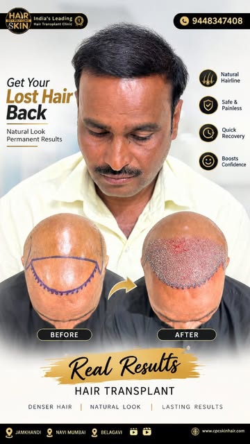 🔥 **GRADE 7 HAIR LOSS — A REMARKABLE HAIR TRANSPLANT TRANSFORMATION!** 🔥

When advanced hair loss 