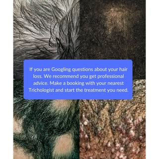 Hair Loss (Alopecia)
While often visible as a hair concern, many types of hair loss originate with s