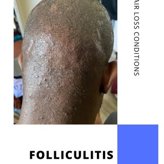 Folliculitis is a common scalp and skin condition that occurs when hair follicles become inflamed an
