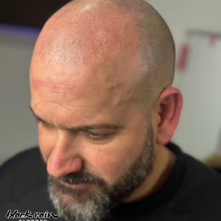 MICRO CAPILAR - 1ª SESIÓN FINALIZADA ✅ 
TÉCNICA EXCLUSIVA LEAL’S - HIPERREALISMO

EL OBJETIVO DE EST