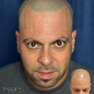 MICRO CAPILAR EFECTO RAPADO HIPERREALISTA 🔥
MÁXIMA NATURALIDAD EN CADA FOLÍCULO, NO CREO, RECREO.
¿