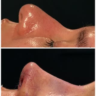 Mais do que um resultado, a rinoplastia significa sonho, significa autoestima, conquista, felicidade