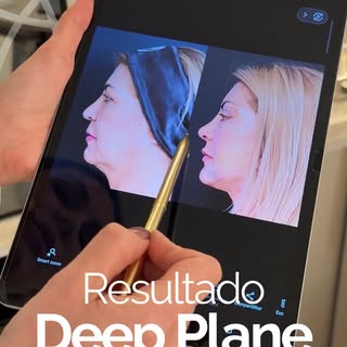 Uma das cirurgias que mais amo realizar e que tão impacta na autoestima dos meus pacientes! Face Lif