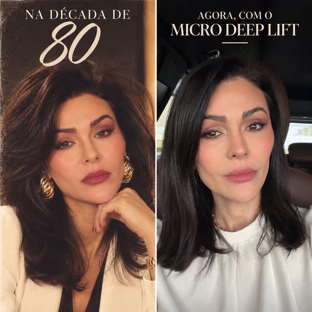O Micro Deep Lift ou o lifting facial de hoje mantém o seu rostinho da década de 80. 🤍

Entrando na