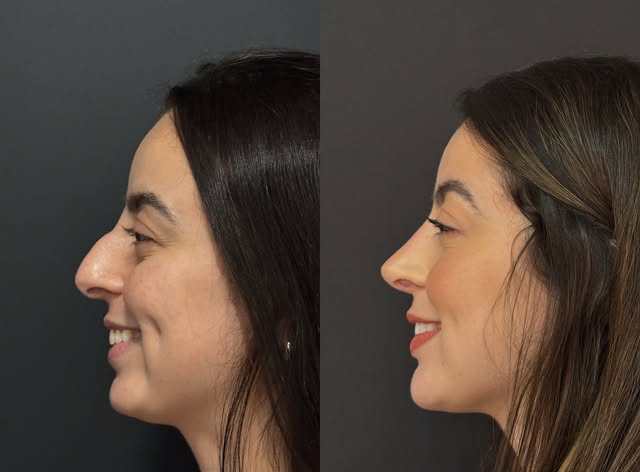 Rinoplastia Primária Ultrassônica!! Mais do que estética e harmonia da face, devolvemos autoestima e
