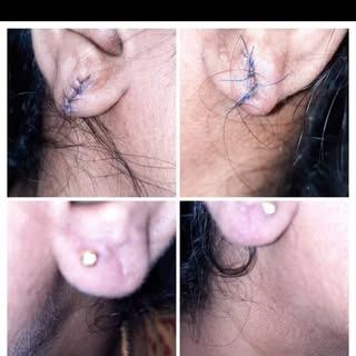 Earlobe is simple ,quick outpatient procedure for torn split,stretched earlobes,performed under loca