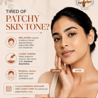 Laser toning can help reduce stubborn pigmentation patches.
#Melasma #Lasertoning #Skinglow #Pigment