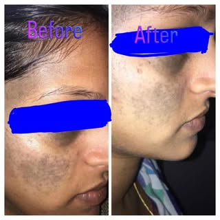 Nevus of Ota is a benign unilateral birth mark with blue gray or slate gray color,gold standard trea