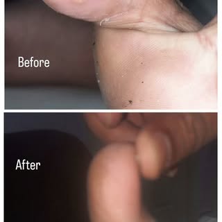 Immunotherapy for plantar warts which are painful and notorious for recurrence if removed by cautery