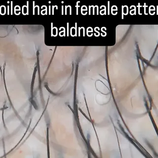 Tricoscopy findings:coiled hair which is typical of trichotillomania (hair pulling) also found in fe