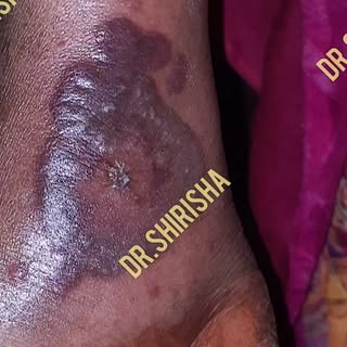 #dermatologist #granuloma annulare#autoimmune#arthritis#raised crpmedical treatment