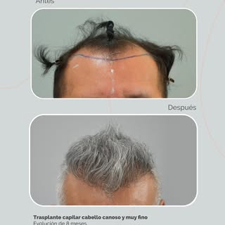 Trasplante capilar en cabello canoso y fino
En casos como este, cada detalle importa. Por eso teñimo