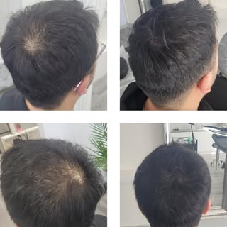 Scalp Micropigmentation for Bald Spots

🧑 Before: Visible patch, confidence fading
🧑‍🦲 After: Sea