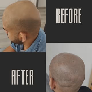 Completely bald to confidently buzzed
Our SMP treatment gives you the look of a full buzz cut with a