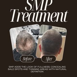 Thinning crown? You’re not alone
Our SMP treatment adds the look of real hair density with no surger