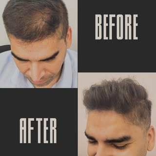 Before & After: Hair Density SMP 👇

This client came in with thinning hair, especially on top — and