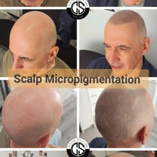 Scalp Micropigmentation Melbourne – The Buzzed Look Hair Loss Fix 👌

Forget hair transplants. Forge