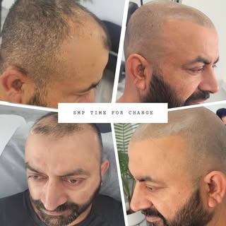 Scalp Micropigmentation Melbourne – Buzzed Look Style 🔥

Looking for a clean, sharp, and confident 