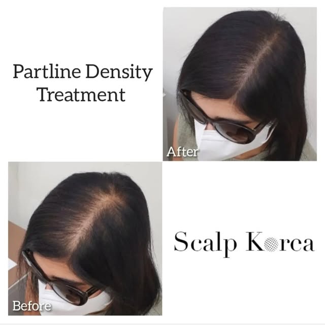 At 𝐒𝐜𝐚𝐥𝐩 𝐊𝐨𝐫𝐞𝐚, we understand that hair loss can affect confidence in many ways. Our goal 