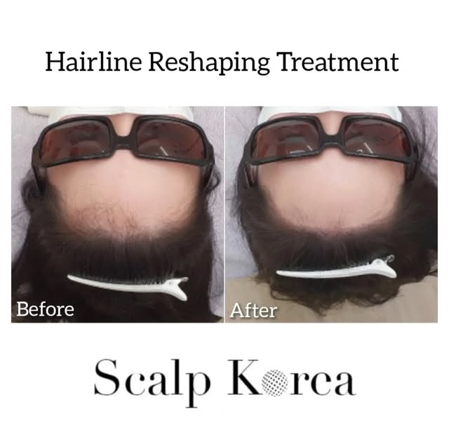 🇺🇸 At Scalp Korea, our mission is to enhance the lives of our clients. From the first consultation