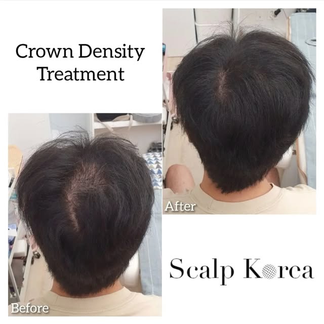 🇺🇸 At Scalp Korea, our mission is to enhance the lives of our clients. From the first consultation