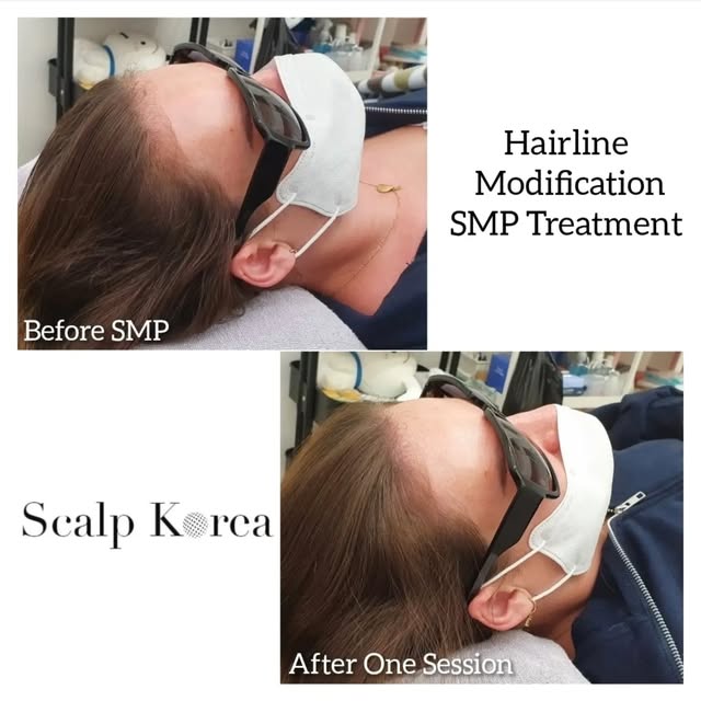 At 𝐒𝐜𝐚𝐥𝐩 𝐊𝐨𝐫𝐞𝐚, we understand that hair loss can affect confidence in many ways. Our goal 