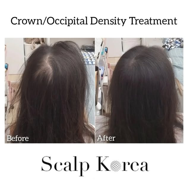 🇺🇸 At Scalp Korea, our mission is to enhance the lives of our clients. From the first consultation