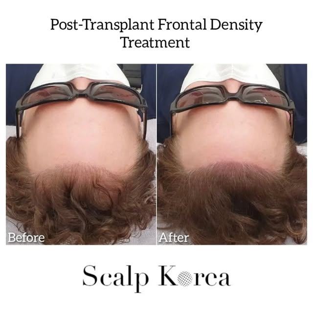 🇺🇸 At Scalp Korea, our mission is to enhance the lives of our clients. From the first consultation
