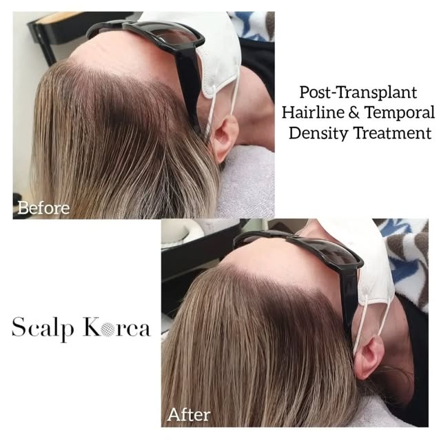 🇺🇸 At Scalp Korea, our mission is to enhance the lives of our clients. From the first consultation